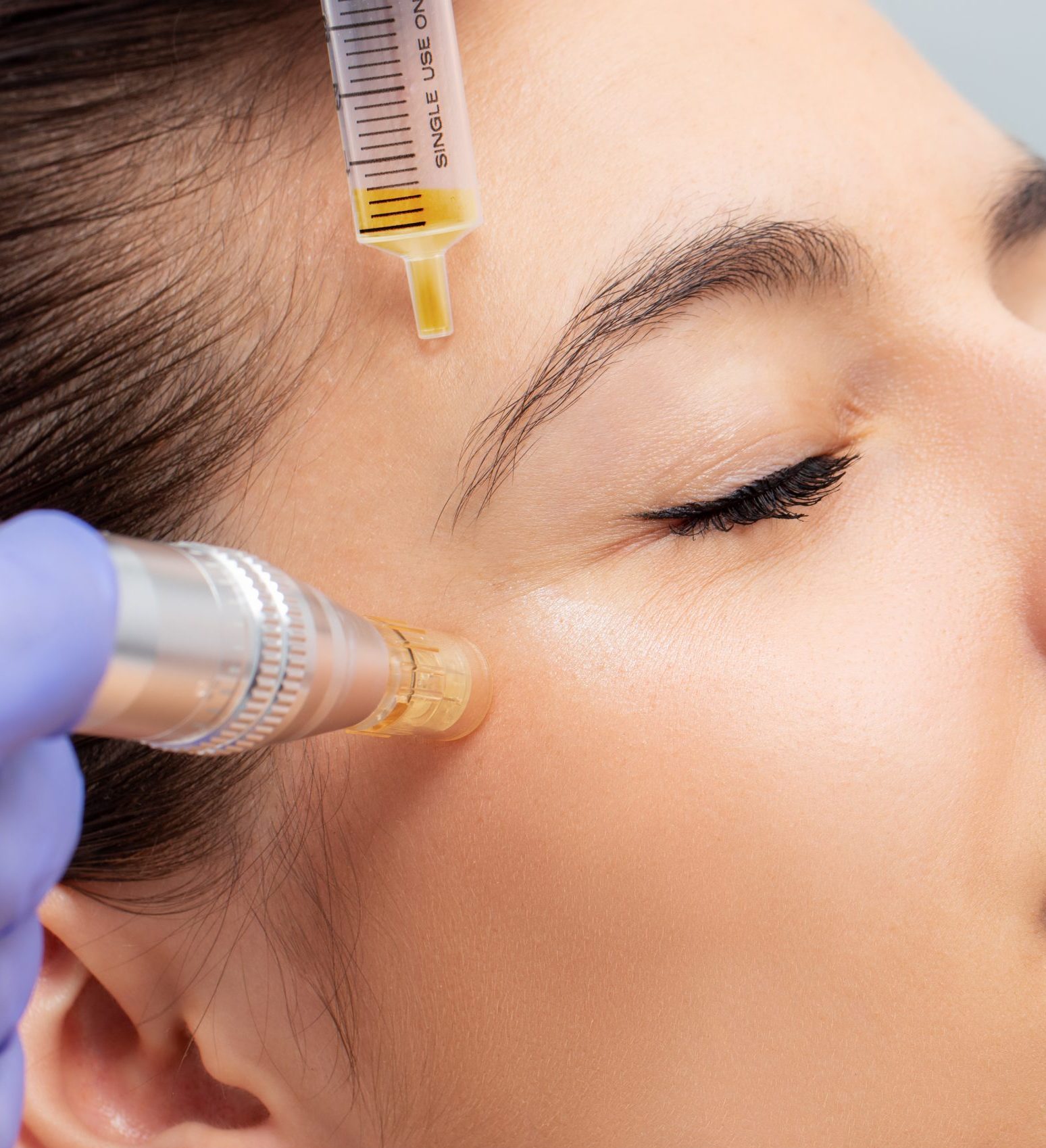 Woman having micro needling treatment reducing crow’s feet Macro close up of therapist injecting enzymes and with derma pen around woman's eyes.